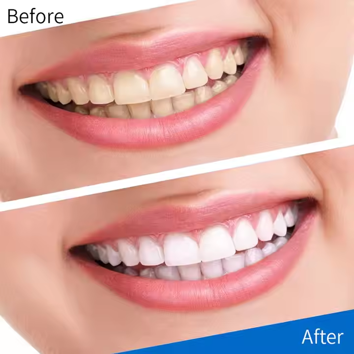 Teeth Whitening Strips